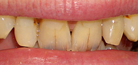 Before Crown