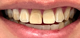 Before Crown and Veneer