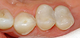 After Filling Replacement