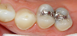 Before Filling Replacement
