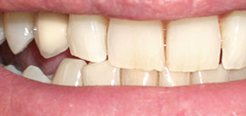 After Implant