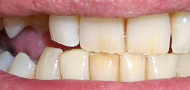 Before Implant