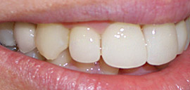 After Implant Crown