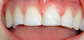 After Tooth Whitening