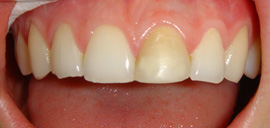 Before Tooth Whitening